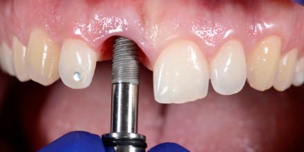 triodent